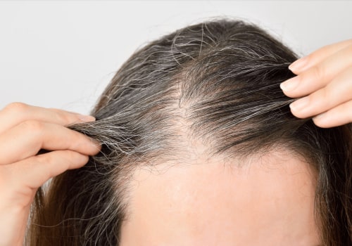 From Natural Remedies To PRP Treatment: Your Journey To Regaining Your Hair In Flushing, NY